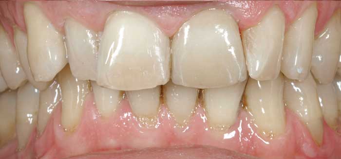 Tratamiento con carillas dentales