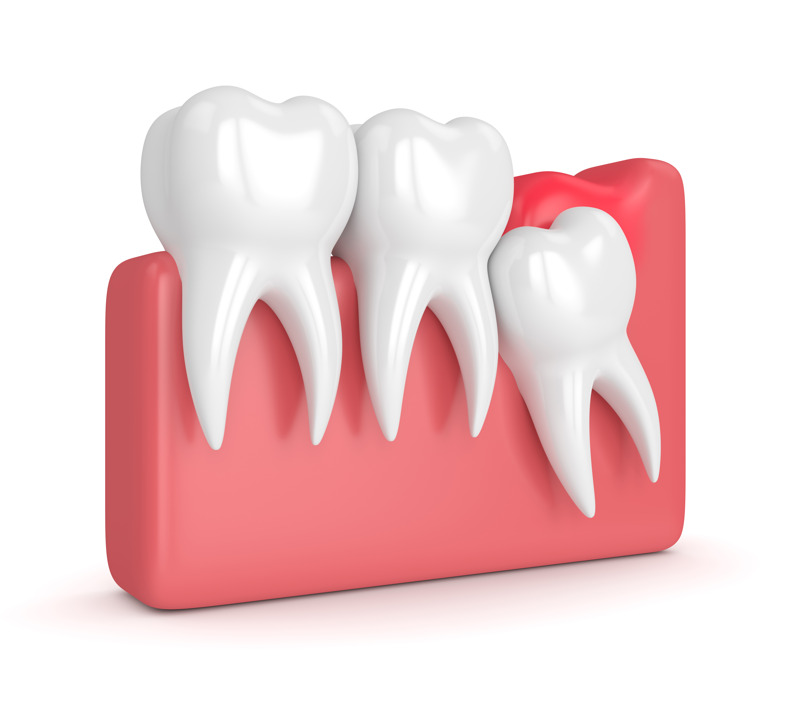 Causas extracciones dentales