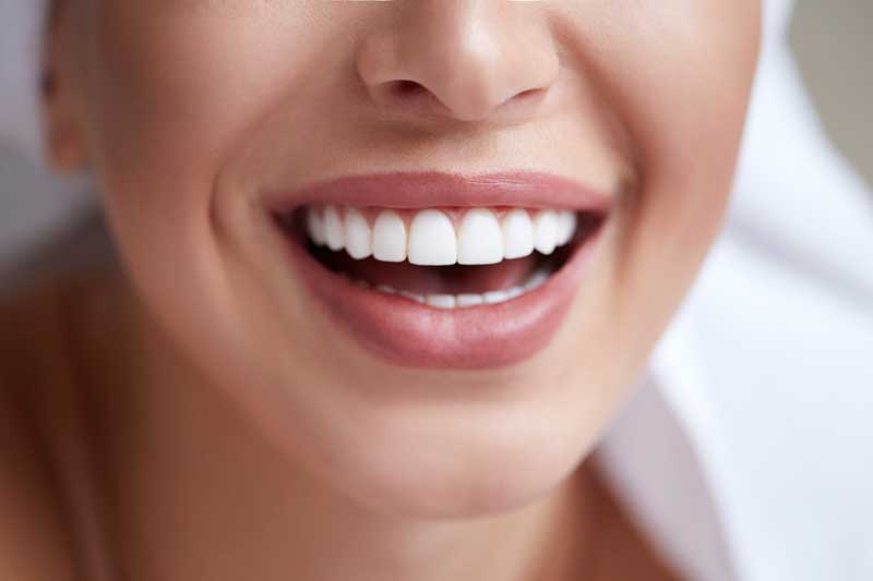carillas dentales ideales para imperfecciones dentales
