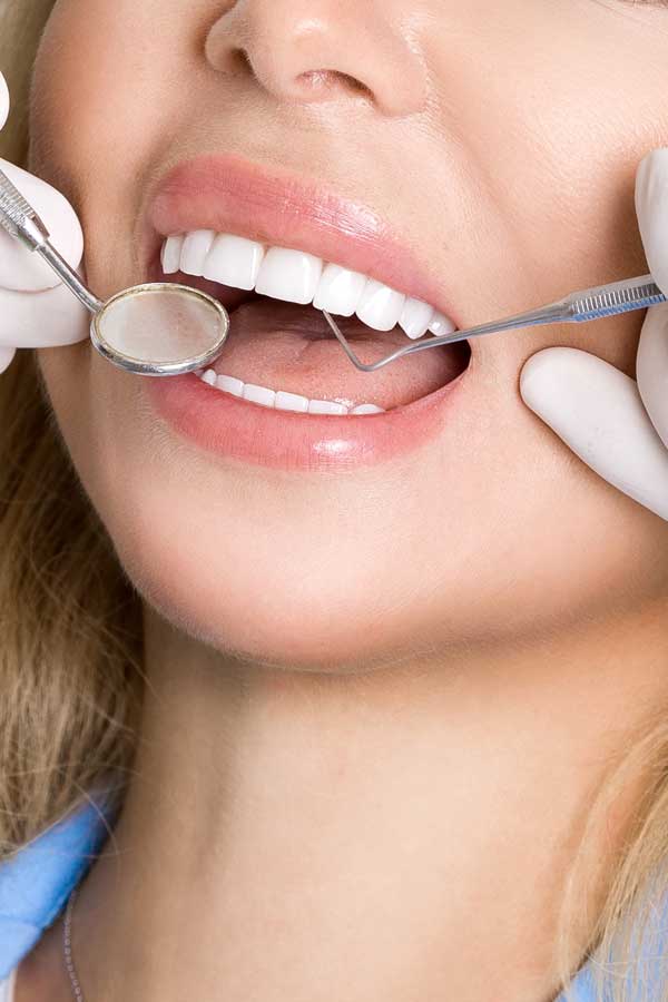 carillas dentales ideales para imperfecciones dentales