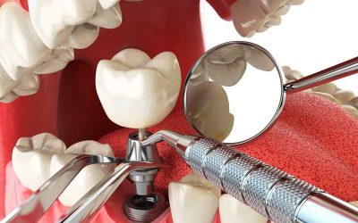 ¿Cómo detectar una infección en implante dental?