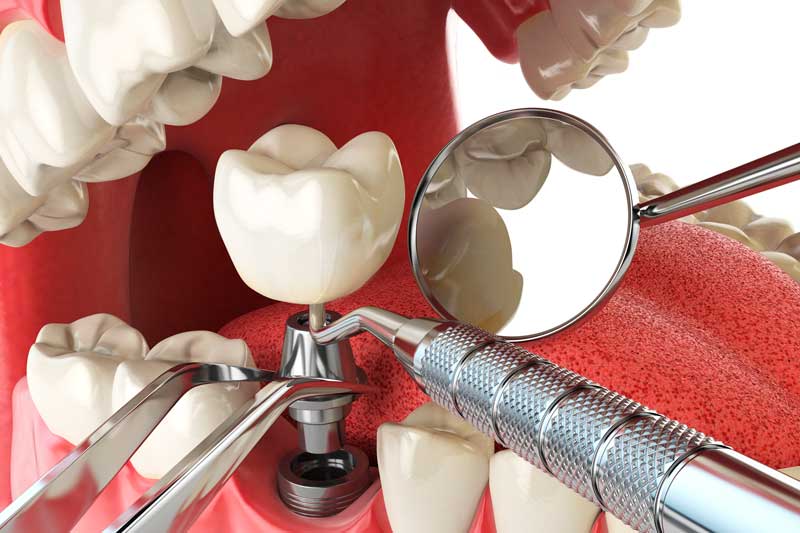 ¿Cómo detectar una infección en implante dental?